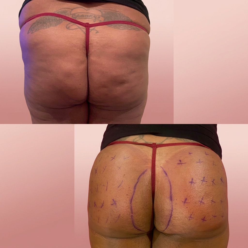 20ml Butt Filler before and after — Waistini Body