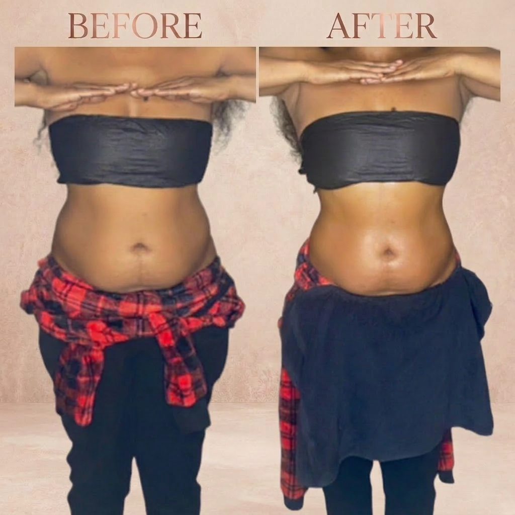 Lipo Cavitation before and after — Waistini Body